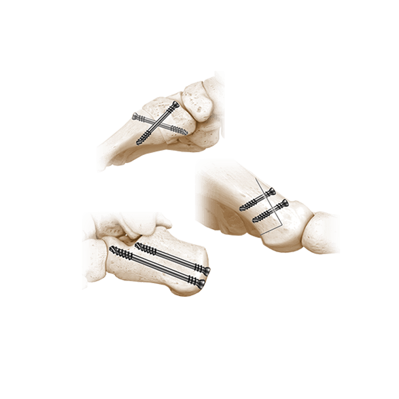 three variations of colag compression screws